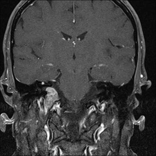 Corona MRI